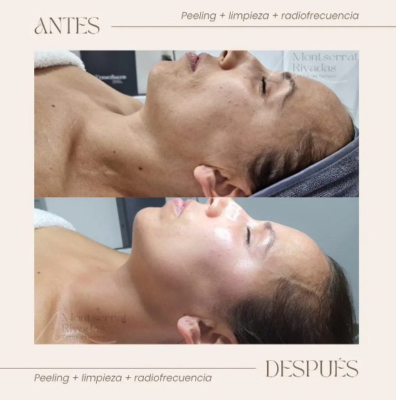 Resultado real antes y después de tratamiento — Montserrat Rivadas