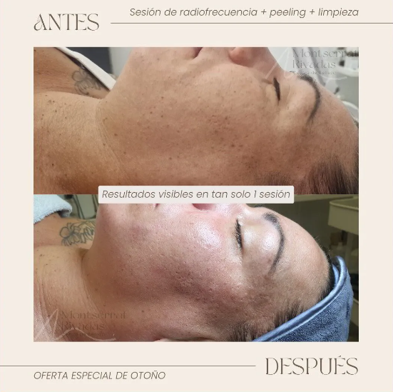 Resultado real antes y después de tratamiento — Montserrat Rivadas