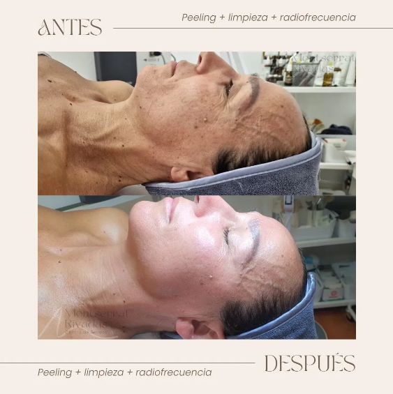 Resultado real antes y después de tratamiento — Montserrat Rivadas