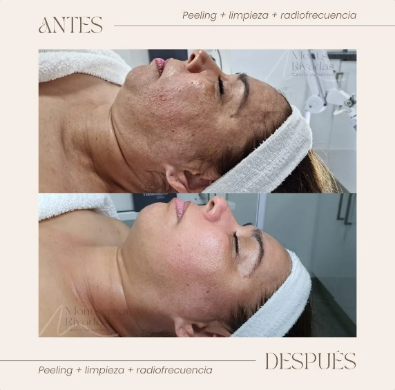 Resultado real antes y después de tratamiento — Montserrat Rivadas